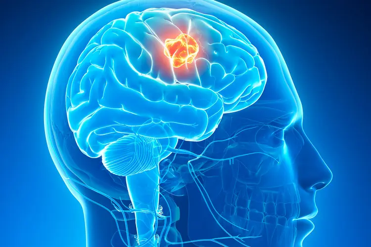Understanding Brain Tumors