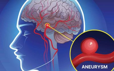 Brain Aneurysm Early Warning Signs