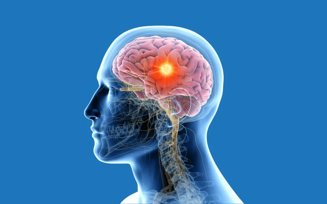 Brain Tumor Myths vs Facts