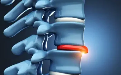 Lumbar Spinal Stenosis: Causes, Symptoms & Modern