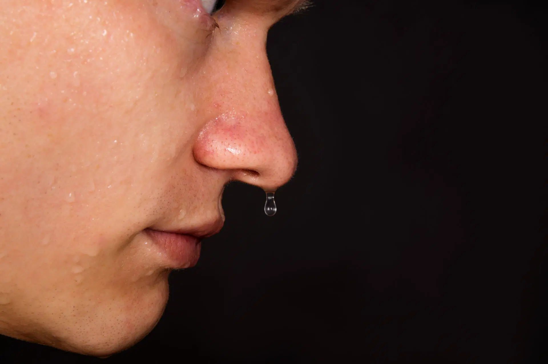 Water Dripping From the Nose for 3 Months