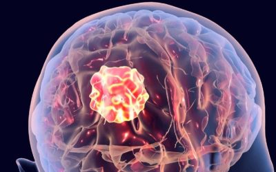 His First Seizure at 36 Was a Brain Tumour in Disguise