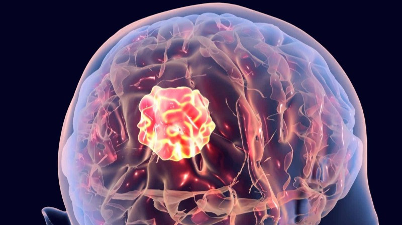 His First Seizure at 36 Was a Brain Tumour in Disguise