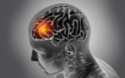 Brain Tumour 10 Myths