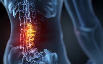 Lumbar Spinal Stenosis